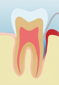 Периодонтит причины