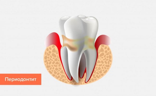 Что такое периодонтит