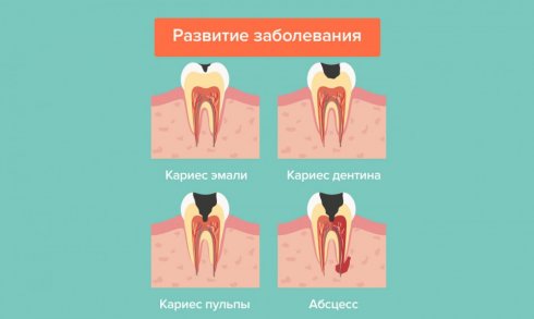 Стадии пульпита